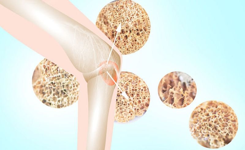 Preparate naturale care ajută și diminuează simptomele osteoporozei